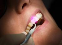 Парадонтоз: как спасти зубы и какие лекарства помогают